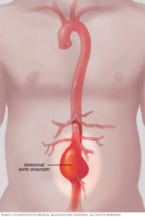 CPT Code 76706 guidelines: a special screening for Abdominal Aortic Aneurysm (AAA) for men 65-75 with a history of smoking.
